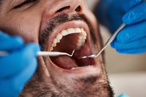 Best Urgent Care for Lost Fillings or Crowns in Mission Viejo, CA